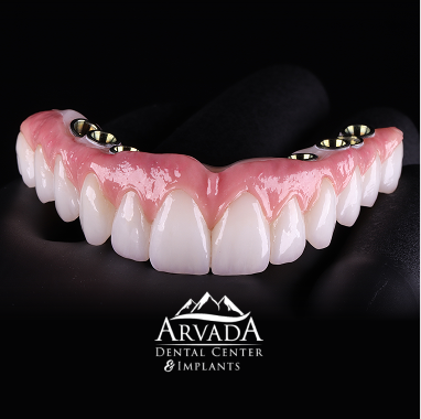 Hybrid Implant Bridge