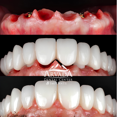 Porcelain Implant Bridge